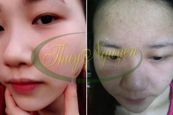 Trị Mụn Đầu Đen, mụn ẩn sâu trong da, mụn cám trên mũi, mụn li ti - MSKH: TN1066